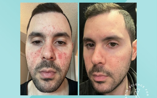 Soteri Skin 2-Step Eczema Starter Kit