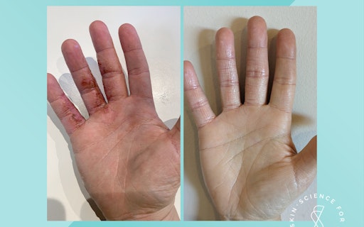 Soteri Skin 2-Step Eczema Starter Kit